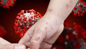 Turkiye de Maymun Çiçeği vakası tespit edildi