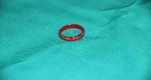 3 yaşındaki çocuğun yemek borusuna sıkışan yüzük, cerrahi müdahaleyle çıkartıldı