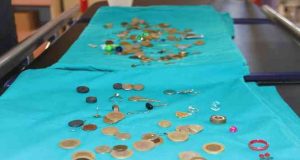 Çocukların nefes borusu ile midesinden çıkartılan yabancı cisimler görenleri hayretler içinde bıraktı