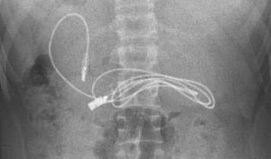 Elazığ’da15 yaşındaki çocuğun karnından telefon şarj kablosu çıktı