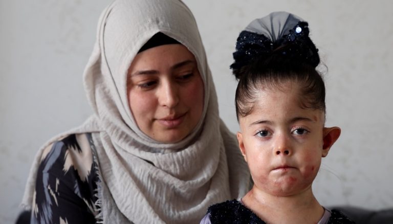 Elazığ’da yaşayan Gülsüm Aydın’ın tek dileği kelebek hastası kızına doyasıya sarılabilmek