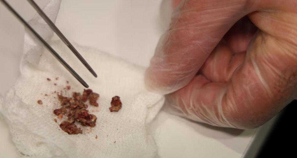 Elazığ’da estetik ameliyatta şaşırtan olay, burundan taş çıktı